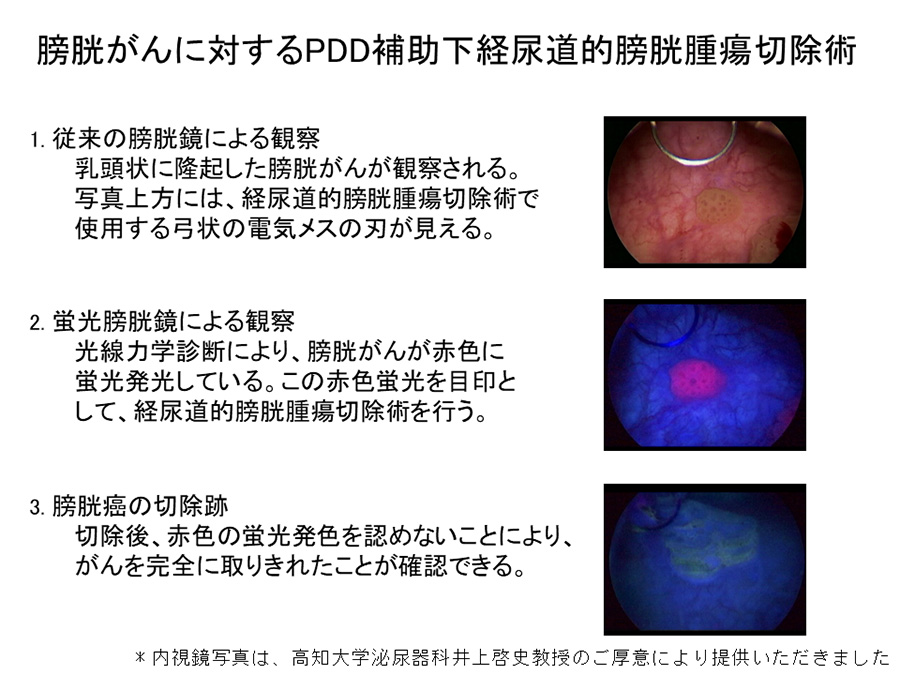 膀胱がんに対するPDD補助下系尿道的膀胱腫瘍切除術